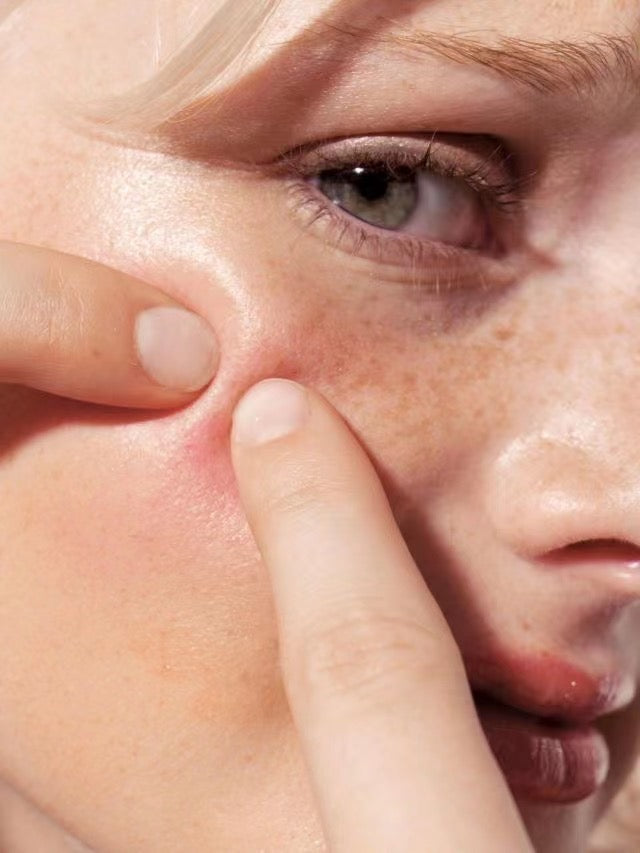 Managing Oily, Sensitive Skin and Compromised Skin Barriers: A Comprehensive Guide