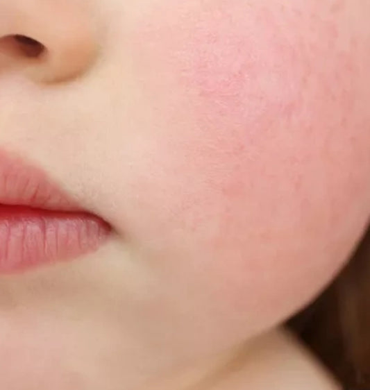 Sensitive Skin, Allergic Reactions, Rosacea, and Itching: In-depth Analysis and Care Guide