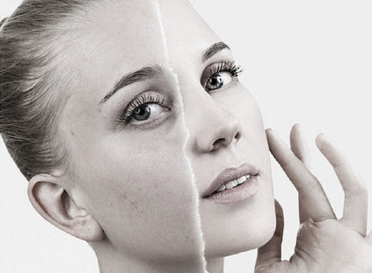 Understanding Hyperpigmentation: Melasma, Sun Spots, and Skin Dullness