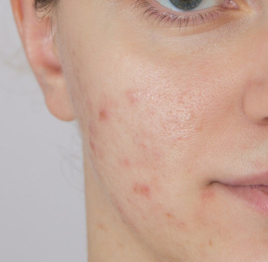 Assessing Skin Health and Effective Oil Control Strategies
