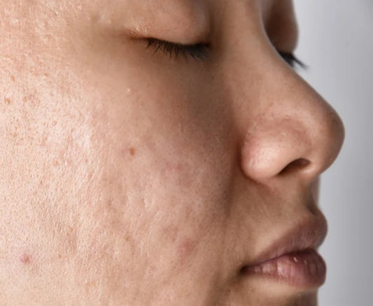 Skincare Guide for Oily and Acne-Prone Skin Vol.02