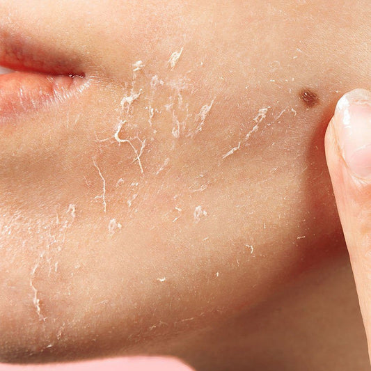 Understanding and Managing Dry Skin and Flaking