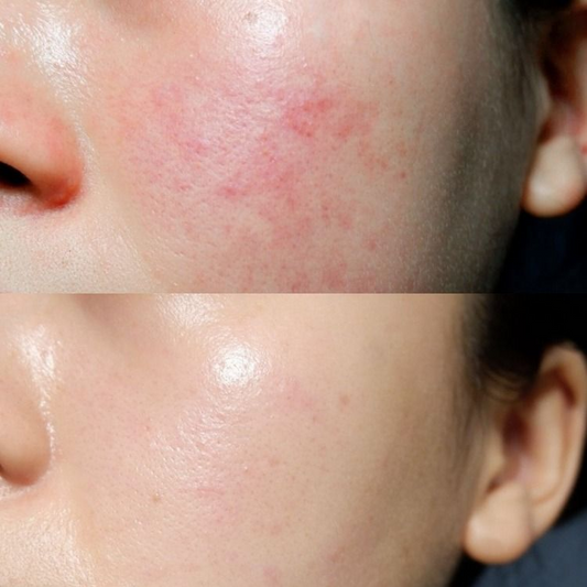 Sensitive Skin Care: Essential Tips and Lifestyle Considerations